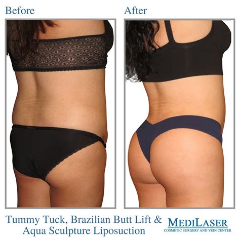 Brazilian Butt Lift Bbl Before And After Medilaser Surgery And Vein
