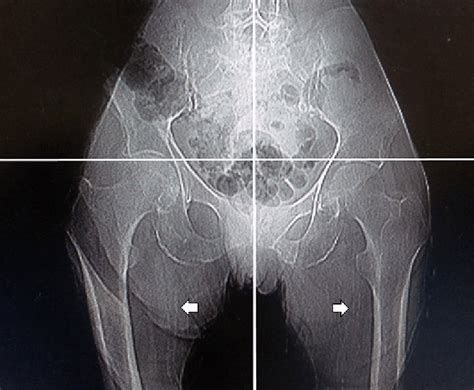 Pelvic Radiography Shows Calcification Of The Femoral Arteries Simple