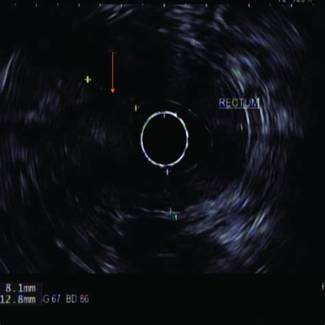 A Radial Rectal Endoscopic Ultrasound Image Showing An Irregular