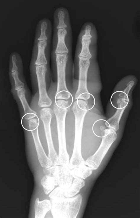 In One Subject The Sesamoid Bones Were Found At Thumb Ipj And All
