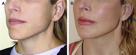 Fat Grafting In Facial Rejuvenation Clinics In Plastic Surgery