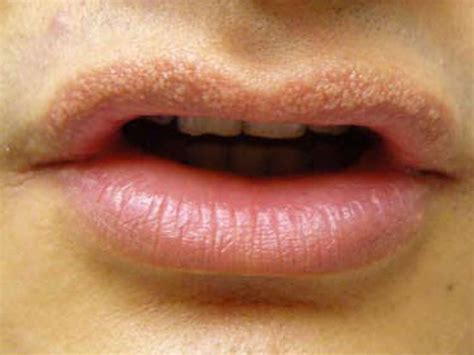 bump on lip causes treatment and when to see a doctor