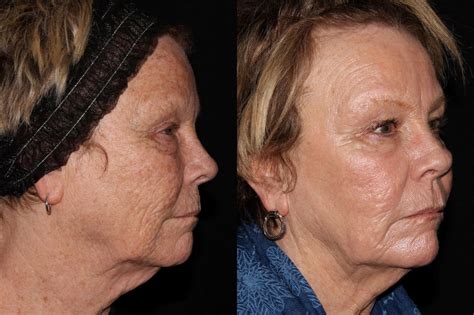 ProFractional Laser Resurfacing Before And After Pictures Case Chico Yuba City