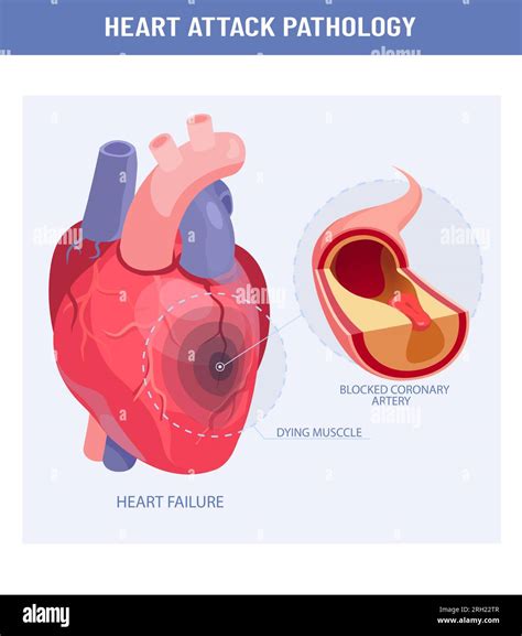 Ataque Al Corazón Y Ateroesclerosis Ilustración Médica Vector De Un