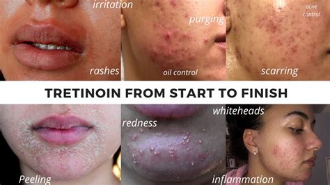 Tretinoin Before And After Full Tretinoin Experience My Journey From