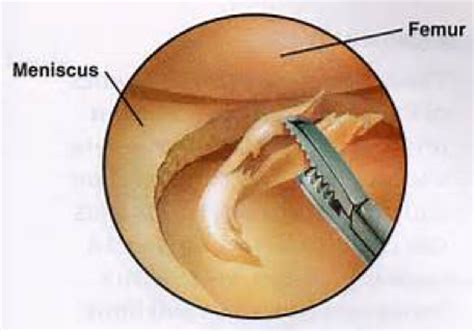 The meniscus are 'c' shaped discs, made of tough cartilage called fibrocartilage. The Different Types of Meniscus Tears (And How They're ...