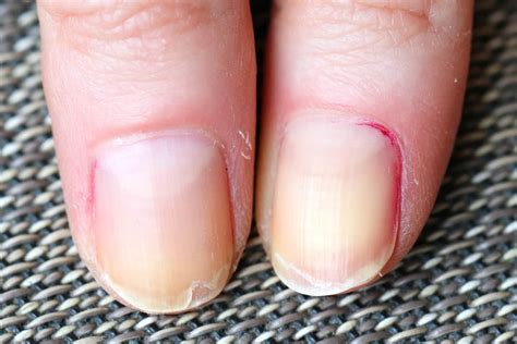 Itchy Cuticles Why It Happens And What To Do