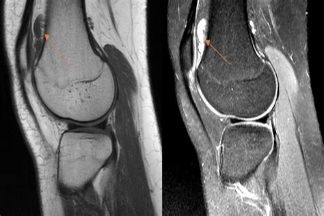 Cureus Giant Cell Tumor Of Tendon Sheath In Knee Capsule