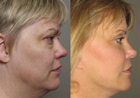 Facelift Photo Patient Guyette Facial Oral Surgery Center
