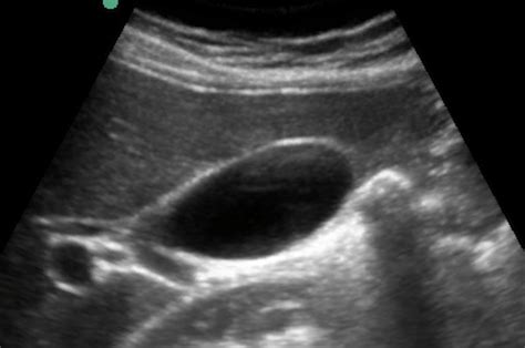 45 Gallbladder Pathology By Ultrasound — Staten Island University