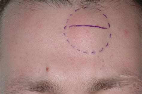 Successful Treatment Of Forehead Lipoma Depends On Knowledge Of The