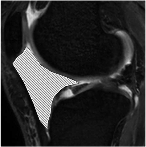 Volume Change In Infrapatellar Fat Pad Is Associated Not With Obesity