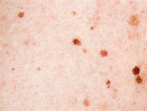 How To Get Rid Of Brown Spots On Skin Cilt Bakımı Aloe Skin Care