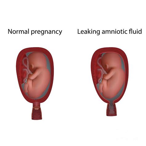 Leaking Amniotic Fluid And Normal Pregnancy Photograph By Veronika