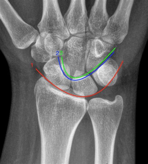 Traumatic Wrist Injury Radiology U Of U School Of Medicine