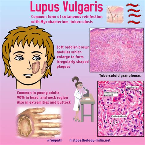 Pathology Of Lupus Vulgaris Cutaneous Tuberculosis Dr Sampurna Roy Md