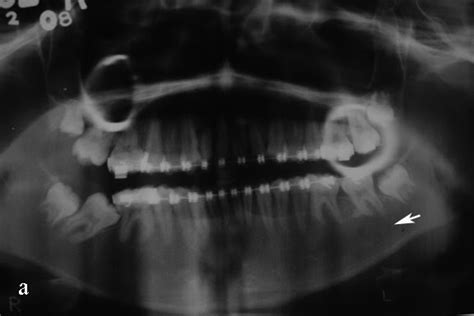 Radiodiagnosis Imaging Is Amazing Interesting Cases Periapical Cyst