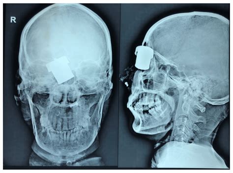 Case Report Two Cases Of Rare Head Injuries From F1000research