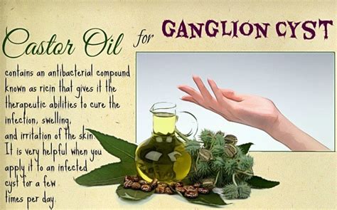 21 Ways On How To Treat A Ganglion Cyst Naturally At Home Page 2