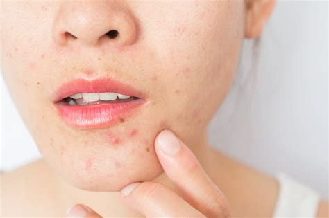 Pcos And Acne Dermatologists Explain Causes And Treatments Popsugar