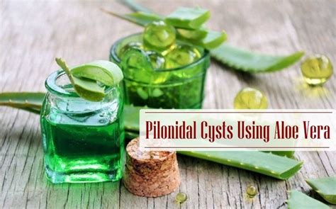 Top 15 Home Remedies For Pilonidal Cysts