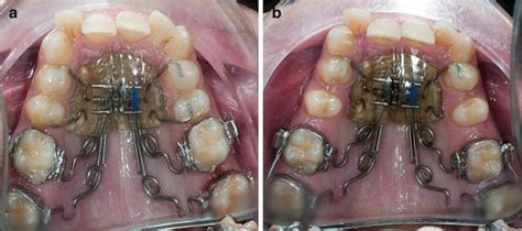Use Of Pendulum With Lingual Appliances Pocket Dentistry