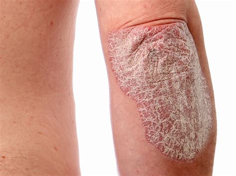 Patients With Psoriasis Should Be Examined For Uveitis