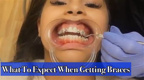 What To Expect When Getting Braces Youtube