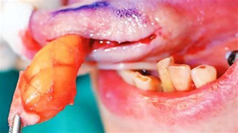 Tongue Cyst Giant Lipoma Case Study Youtube
