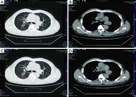 Ct Chest Image Comparison At Different Radiation Doses In The Same Download Scientific Diagram