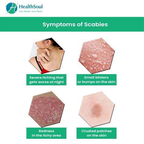 Scabies Diagnosis Treatment Healthsoul