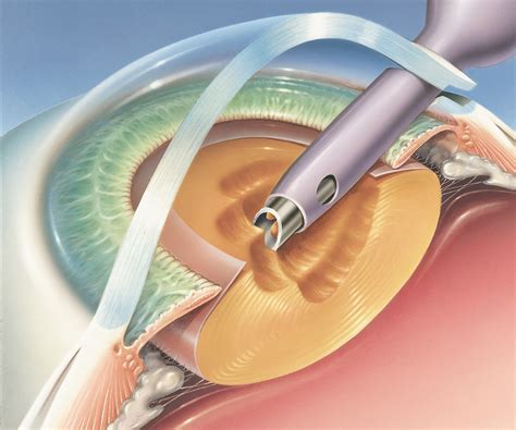 cataract surgery types and per early op and late op c