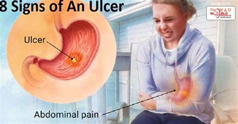 8 Signs And Symptoms Of A Stomach Ulcer You Should Not