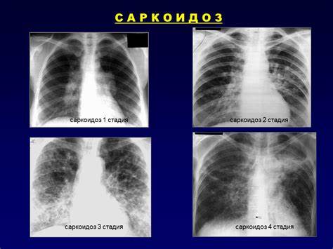 Диета при фиброзе 1 Диета При Фиброзе Легких — Похудение Диета Правильное Питание Диета При Фиброзе Легких — Похудение Диета Правильное Питание Диета при фиброзе 1