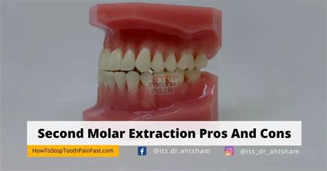 🦷 Second Molar Extraction Pros And Cons 2024