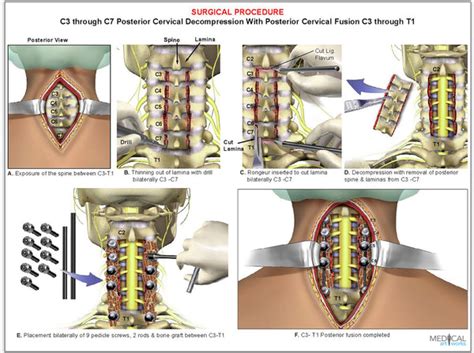 4 Level C3 C7 Cervical Spine Decompression Surgical Procedure — Medical Art Works