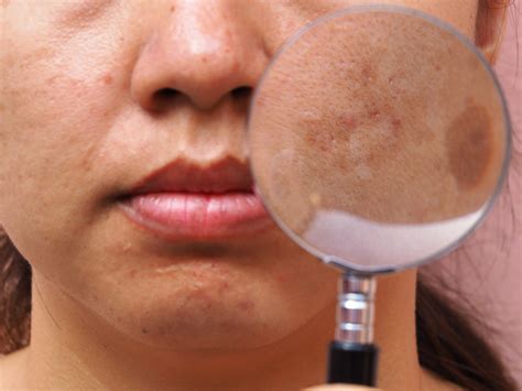 ¿cómo Eliminar Manchas En La Cara Skinexpert