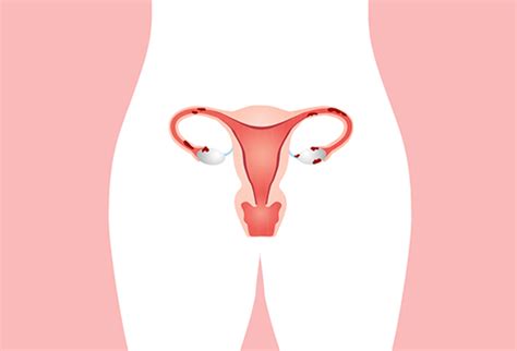 Endometriozis Nedir Doç Dr Çağlar Helvacıoğlu