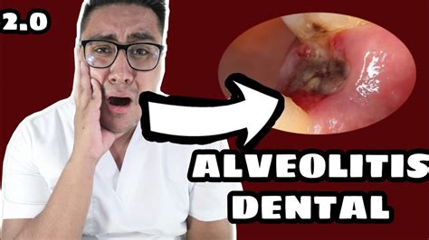Como Puedes Prevenir La Alveolitis Infeccion Despues De Una Extraccion Dental Otosection