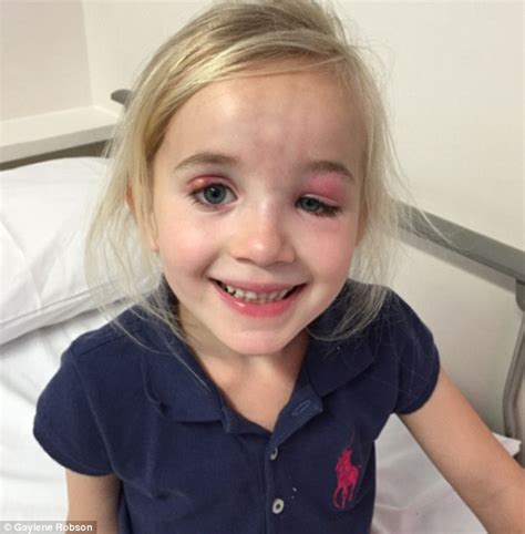 Melbourne Girl Who Went To The Doctor With A Puffy Eye Had A Tumour On