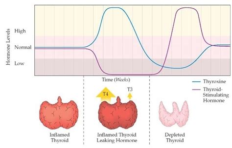The pathology of thyroiditis, hum. Thyroiditis