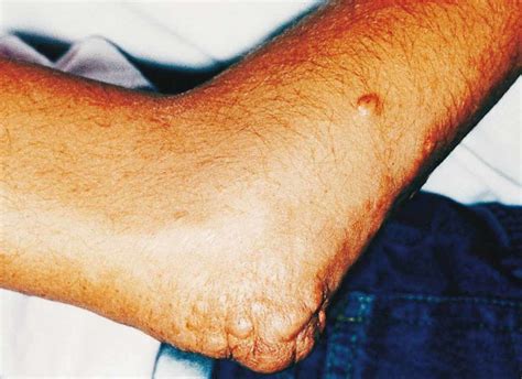 Tendinous Xanthomas And Xanthoma Tuberosum In The Elbow In Case 2