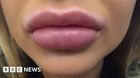 Ban Botox Style Injections And Lip Fillers For Under S In Wales