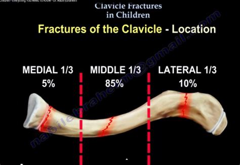 Clavicle Fractures In Children —