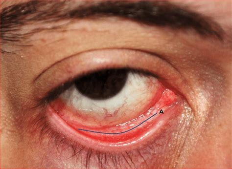 Access Transconjunctival A Indicating The Position Of The Incision Download Scientific