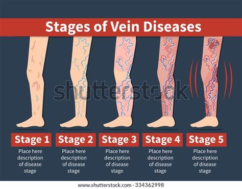 Vector Varicose Infographic Stage Vein Diseases Stock Vector Royalty