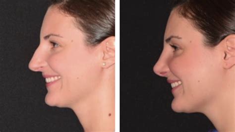 Rhinoplasty Before And After Compilation Youtube
