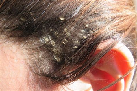 What Causes Scalp Sores And Some Natural Treatments