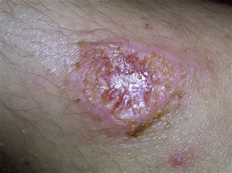 Parasites Of Skin Am Flashcards Quizlet