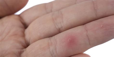 The Best Way To Remove A Splinter Mens Health